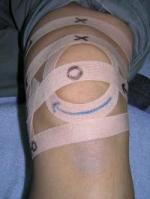 変形性膝関節症のヒーリングテープ